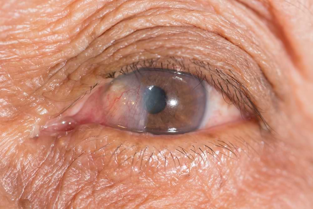 pterygium removal in sydney