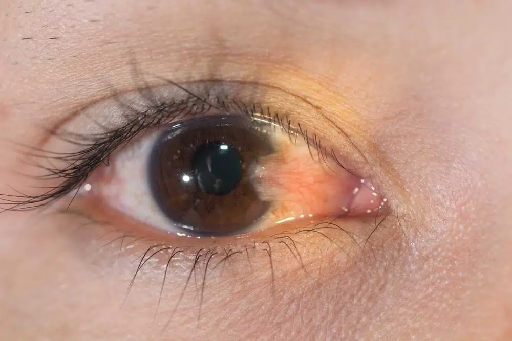 pterygium treatment in sydney