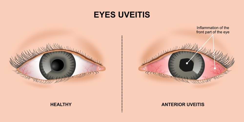 anterior uveitis illustration of treatment