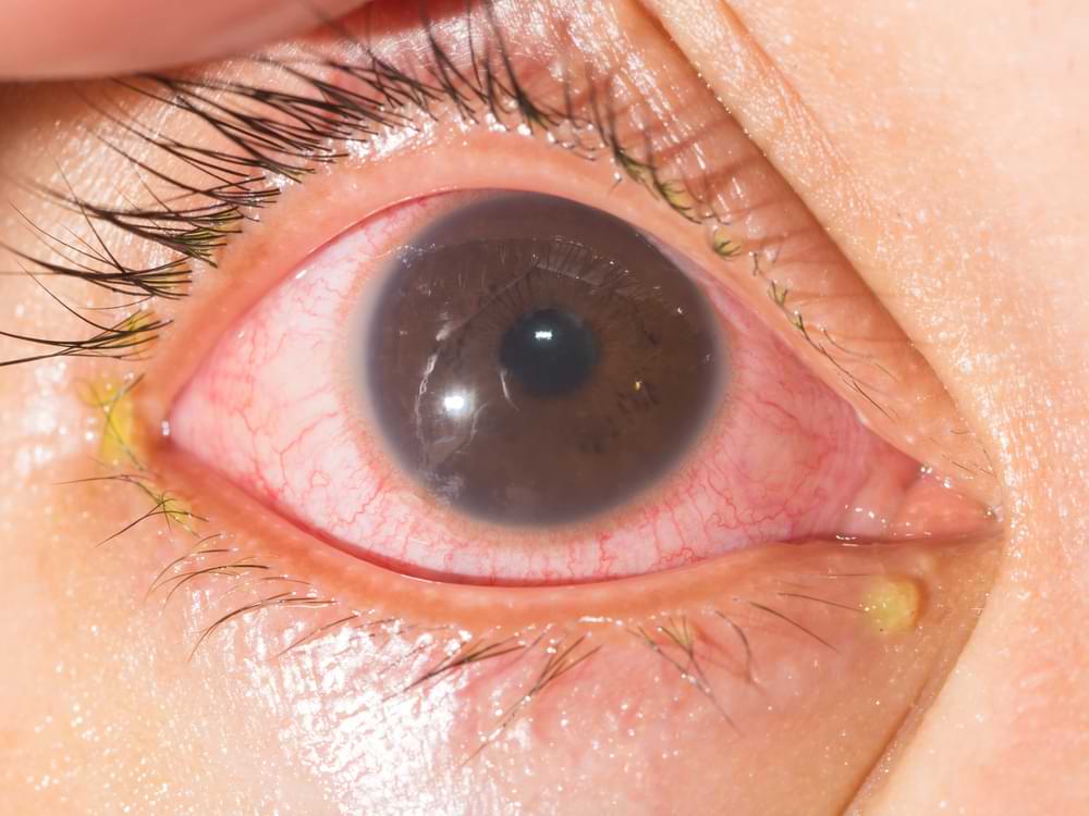 Uveitis Treatment In Sydney