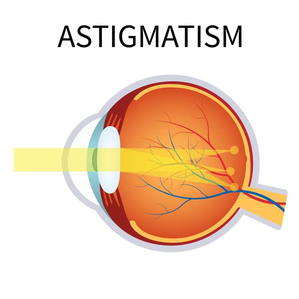 astigmatism illustration