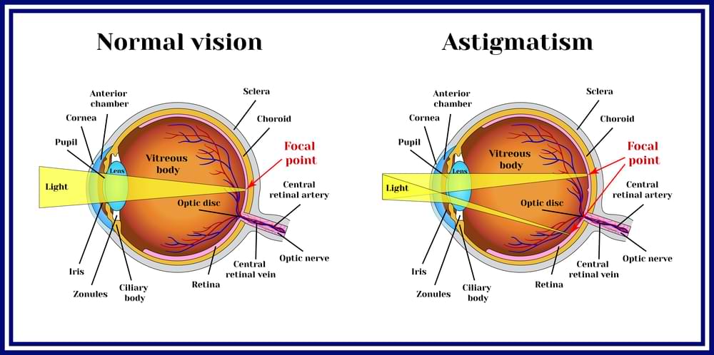 astigmatism laser vision correction in sydney
