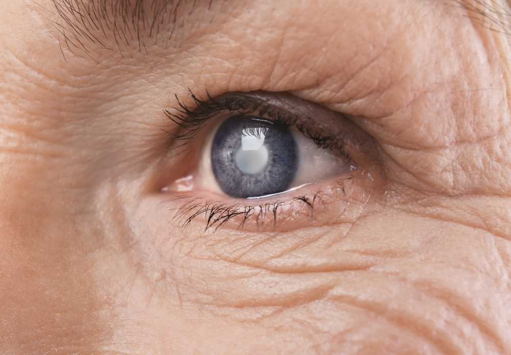 cataract lens replacement in sydney