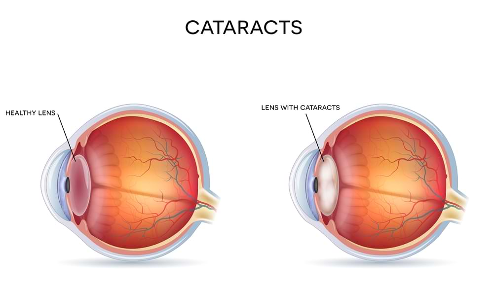 cataract surgery sydney