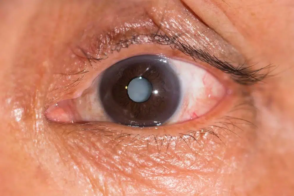 cataract surgery in sydney and what to expect