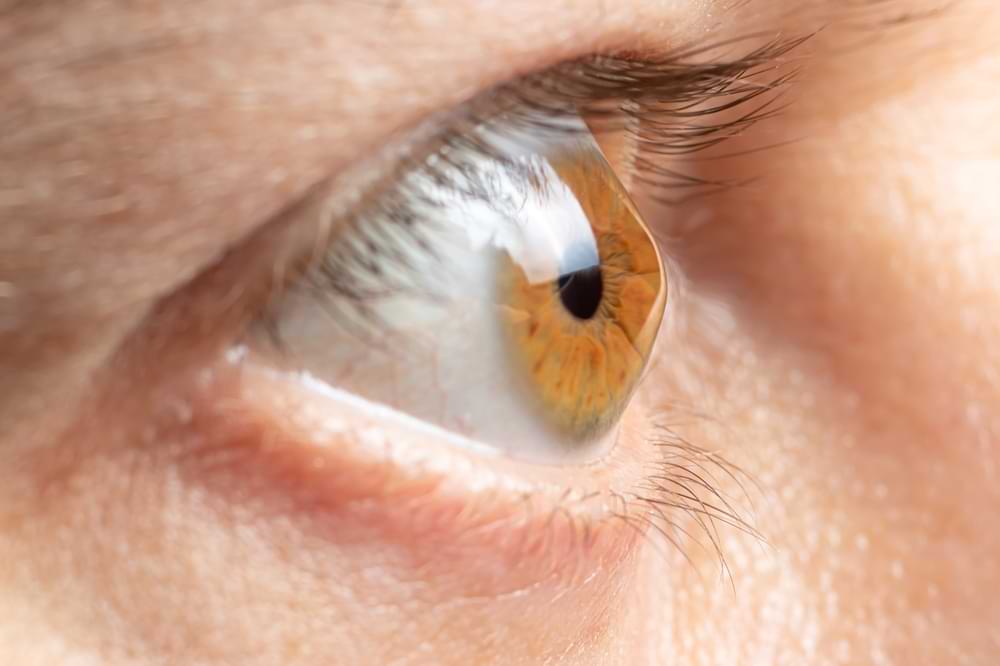 keratoconus treatment sydney