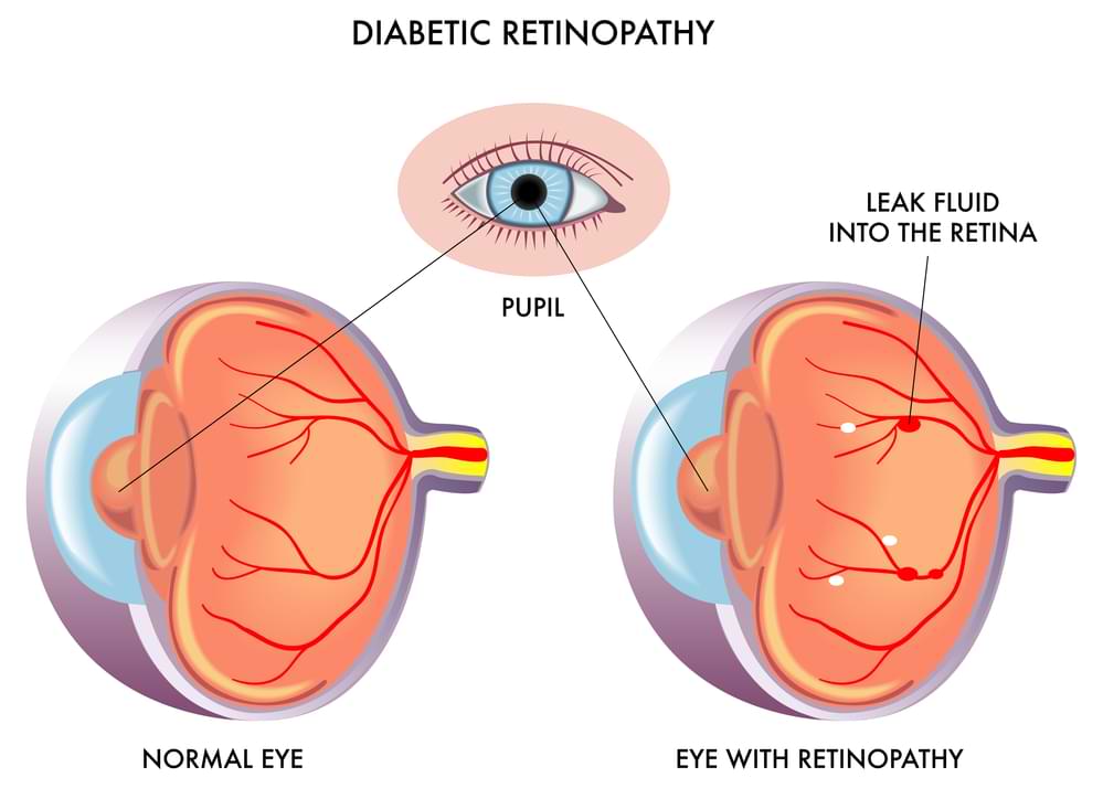 diabetic retinopathy illustrated