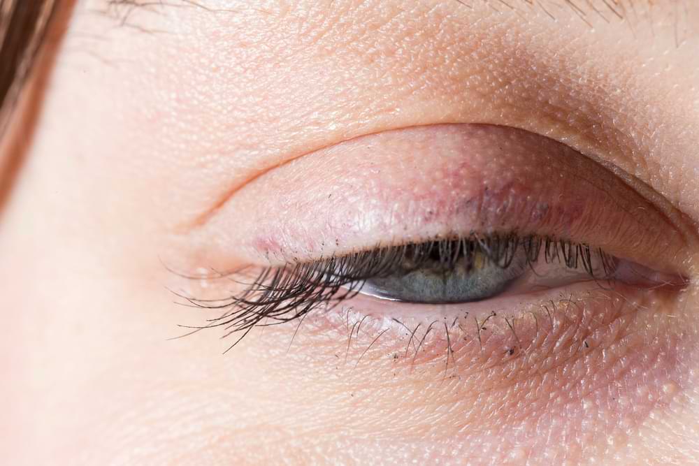 eyelid surgery for drooping eyelid
