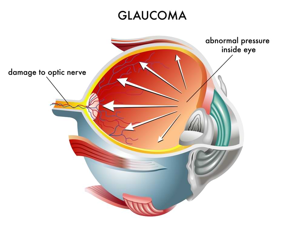 glaucoma eye disease illustrated