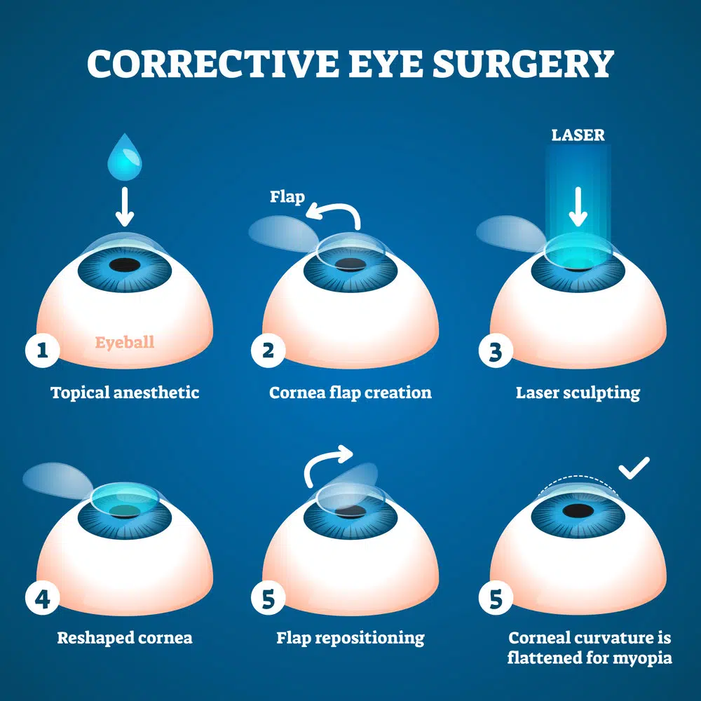 lasik corrective eye surgery