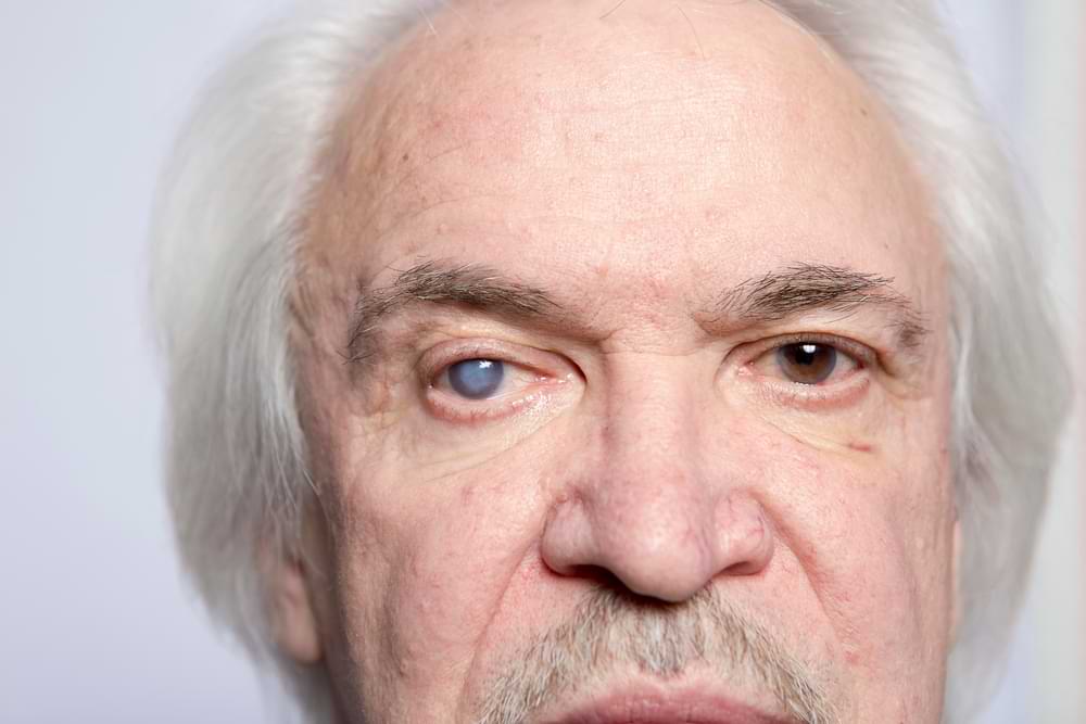 lasik implications for cataract surgery