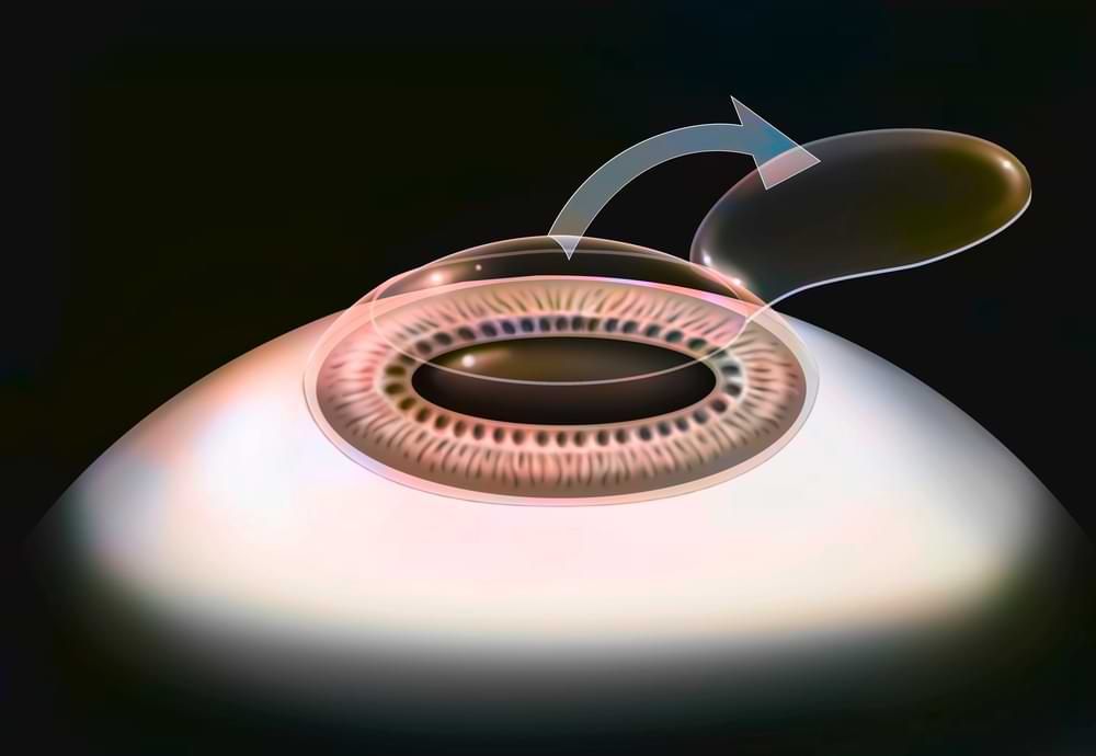 LASIK laser eye surgery illustrated