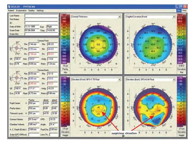 pentacam eye care diagnostics