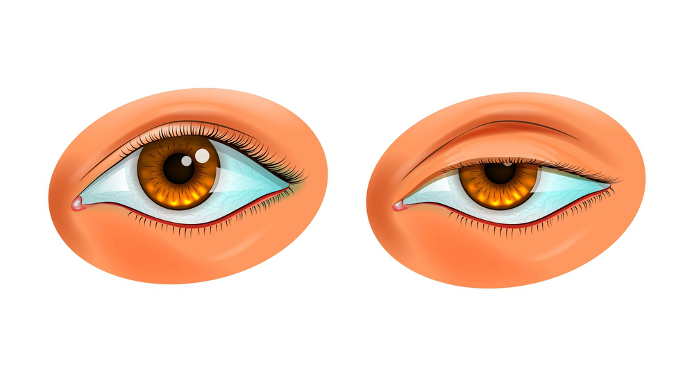 ptosis upper eyelid surgery