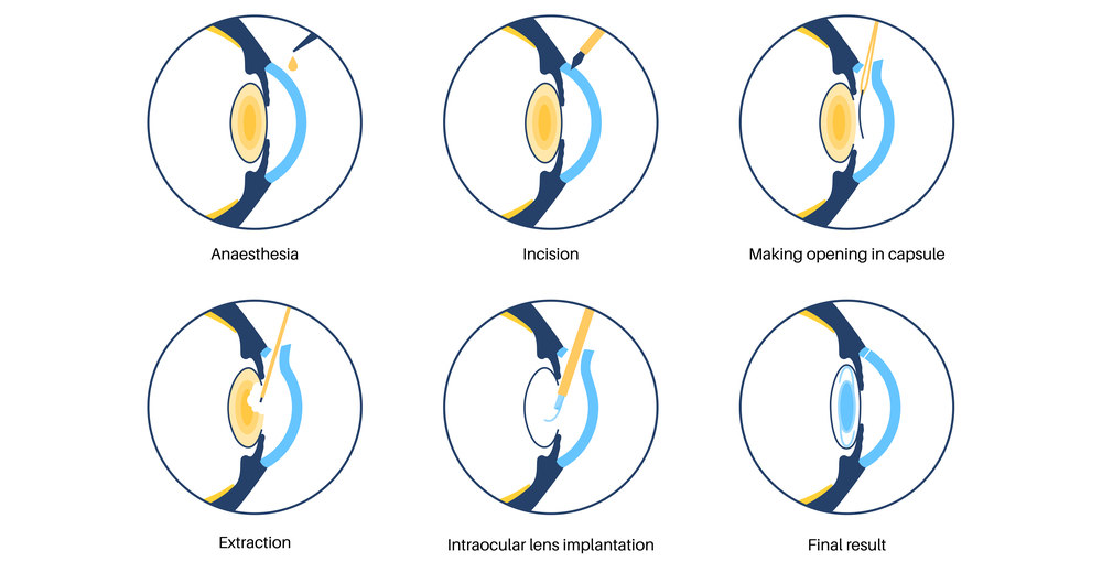 what is clear lens extraction