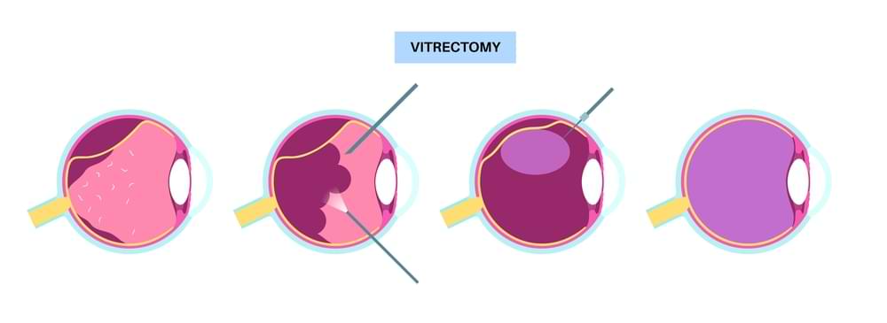 vitrectomy procedure illustration