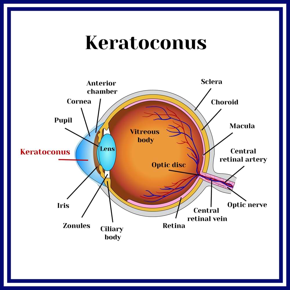what is keratoconus cross-corneal linking